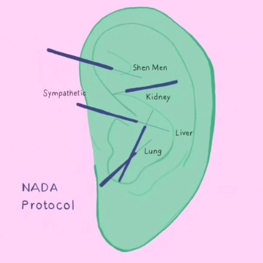 NADA Protocol: A Comprehensive Approach to Trauma and Pain&nbsp;Relief